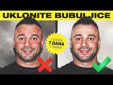 Video: Kako se riješiti bubuljica?