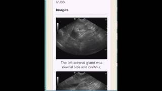 The SonoPath Mobile App Demo by Dr. Eric Lindquist screenshot 4