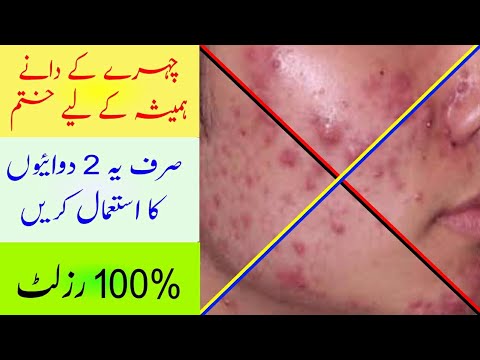 How to get rid of pimples || Pimple&#;s treatment || Acne || Acne vulgaris || Taimoor Azeem