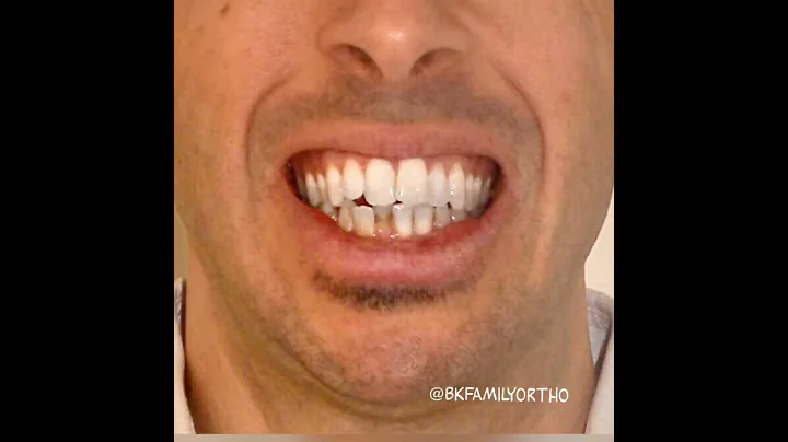 Incognito Braces transformation