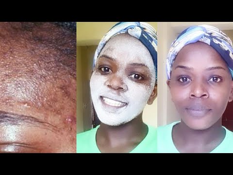 DIY / How To Remove Pimples Naturally / Acne scar Treatment