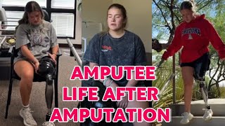 Life After Amputation Walking With Prosthetic Leg Freely