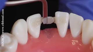 Ribbond Single Visit Bridge Technique | Single visit Teeth |