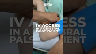 IV Access in a Cerebral Palsy Patient #iv #nurse