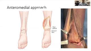 Tibial Plafond Fractures - Dr. Shearer