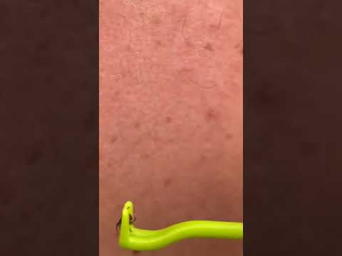 Клещедер - приспособление для удаления клещей