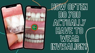 How Often Do You Actually Have to Wear Your Invisalign? #shorts