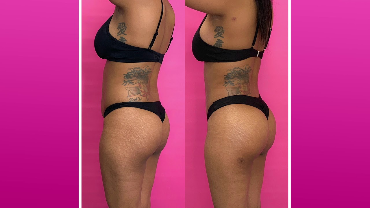 skinny BBL, BBL before and after pics, BBL recovery, skinny girl BBL,...