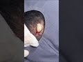 Massive 18 Year Pilar Cyst Gets Removed