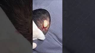 Massive 18 Year Pilar Cyst Gets Removed