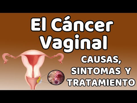 Video: ¿El cáncer de vulva se propaga rápido?