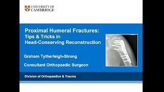 Proximal Humeral Fractures; Tips & Tricks for Head Conserving Surgery