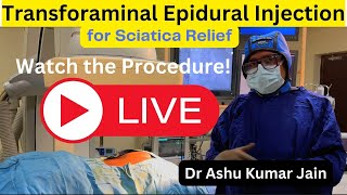 Live   Transforaminal Epidural Injection for Sciatica Relief   Watch the Procedure