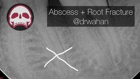 Dental Abscess Incision and Drain and Dental Extraction with Root Tip Fracture and Removal