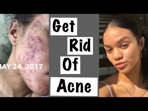 HOW I CLEARED MY ACNE | HORMONAL ACNE | CYSTIC ACNE