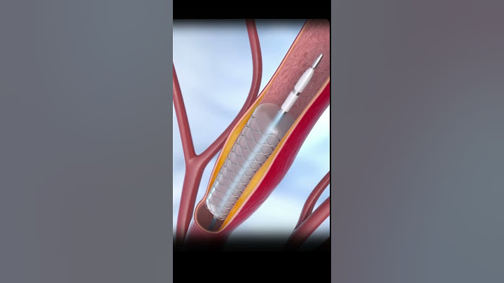 हार्ट में इस तरह लगाया जाता है स्टेंट  Stent Placement in Heart Explained with Animation