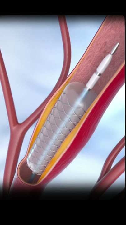 हार्ट में इस तरह लगाया जाता है स्टेंट  Stent Placement in Heart Explained with Animation