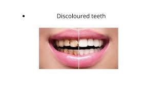 Dental Veneers and Its Benefit1