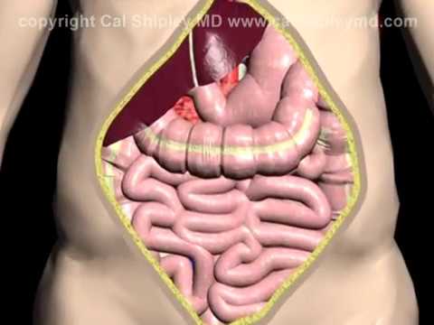 Video: Bypass Aortobifemoral: Chirurgie, Procedură și Complicații