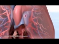 ТЭЛА. Тромбоэмболия легочной артерии.