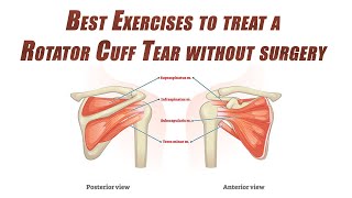 Best SelfTreatment of a Rotator Cuff Tear | Shoulder Rehab without Surgery