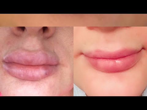 Video: Hierdoor Wordt De Vulling Van De Lippen Verwijderd