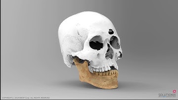 Solutionix C500 - 3D Scan Data of Jawbone (from Korean War)