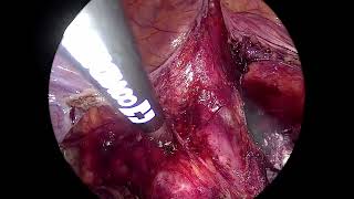 Total Laparoscopic Hysterectomy (TLH) for benign desease: Let images do the talking