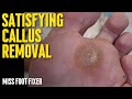 SATISFYING THICKEST AND GIANT CALLUSES REMOVAL