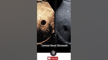 Contrast Based Ultrasound Machine | Biomedical Engineers TV #ultrasoundscans #science #hospital