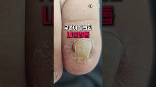 무좀동반 #내성발톱 #내성발톱교정 #파고드는발톱 #발톱성형 #발톱교정 #아픈발톱 #산본내성발톱 #군포내성발톱 #산본네일 #문제성발톱 #내성발톱관리 #포더풋 #산본중심상가