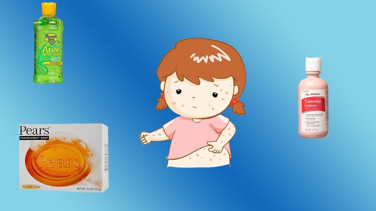 Heat rash ( prickly heat, Miliaria ) treatment home remedy and