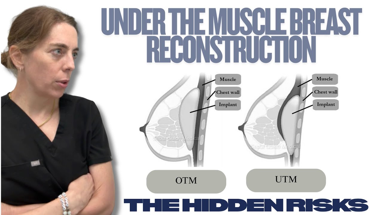 Plastic Surgeon Explains the Hidden Risks of Under-the-Muscle Breast Reconstruction