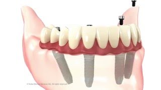 Full All-on-4 patient education animation. Guide