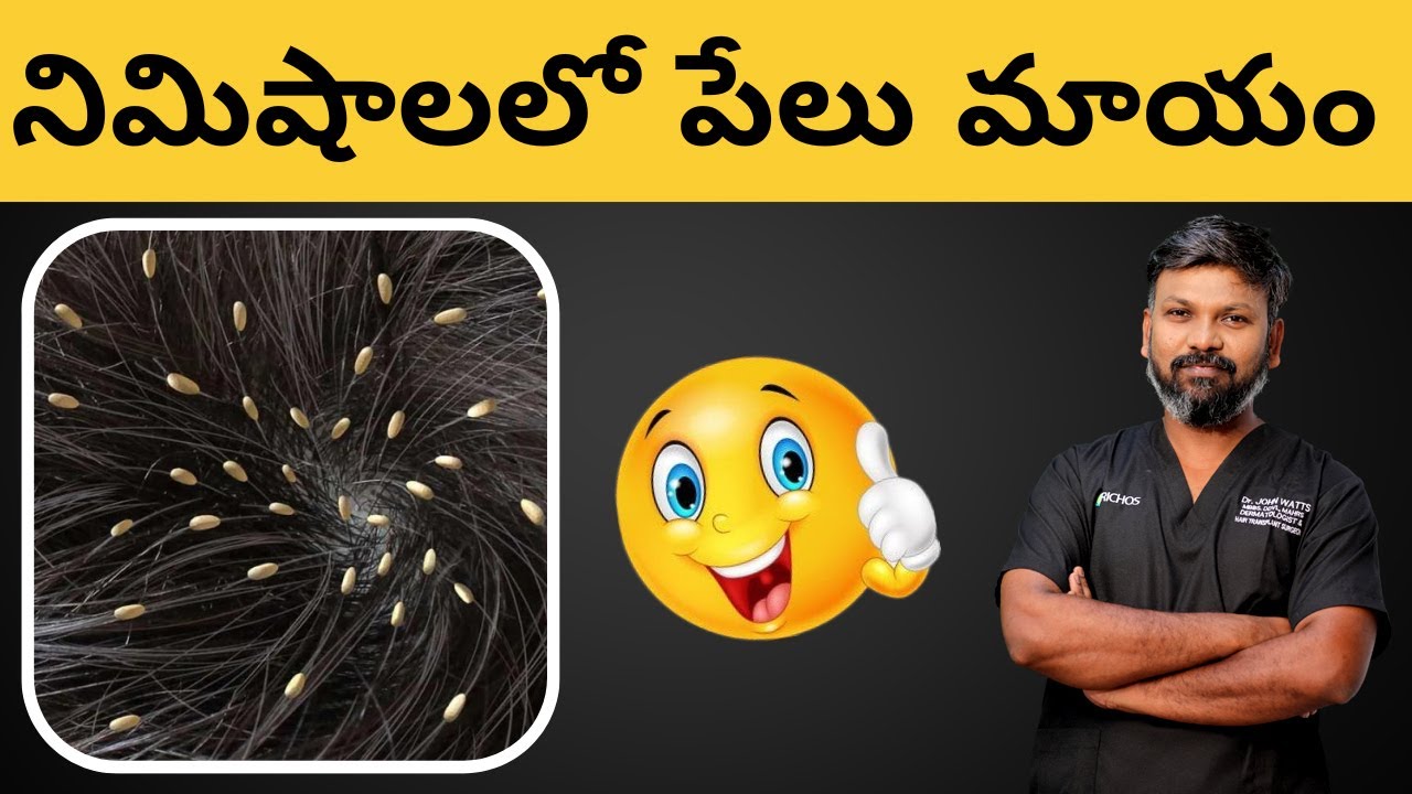 AskDrJohnWatts How to get rid of lice ? Best Hair Specialist in Hyderabad Explains YouTube