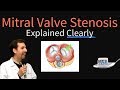 Mitral Valve Stenosis Explained Clearly - Pathophysiology, Symptoms, Treatment
