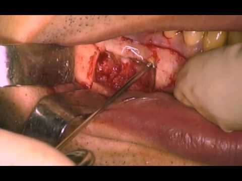 Apicoectomy Of Lower Molars - Bony Lid Technique; Oral Surgery procedure