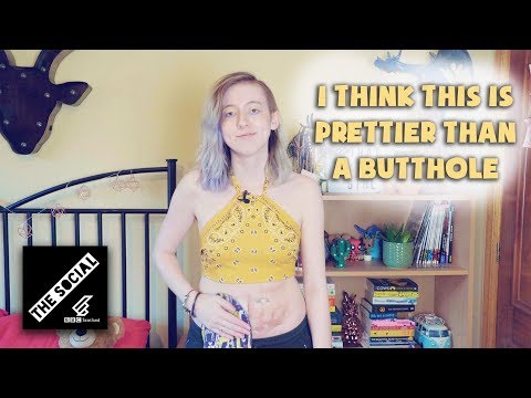 Video: Life With A Ostomy Bag: This Vloggers Honest Take