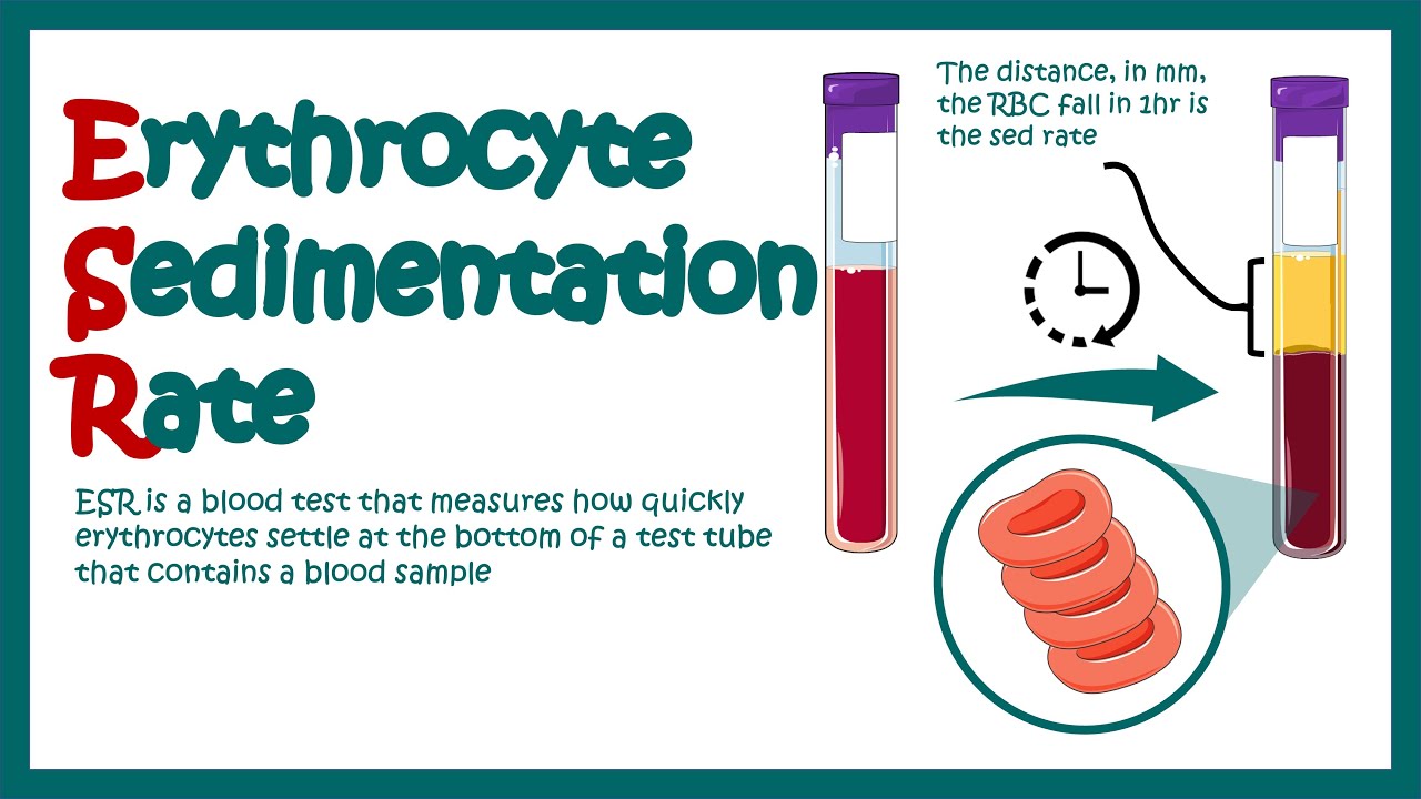 Erythrocyte Sedimentation Rate, ESR, What does ESR test show?