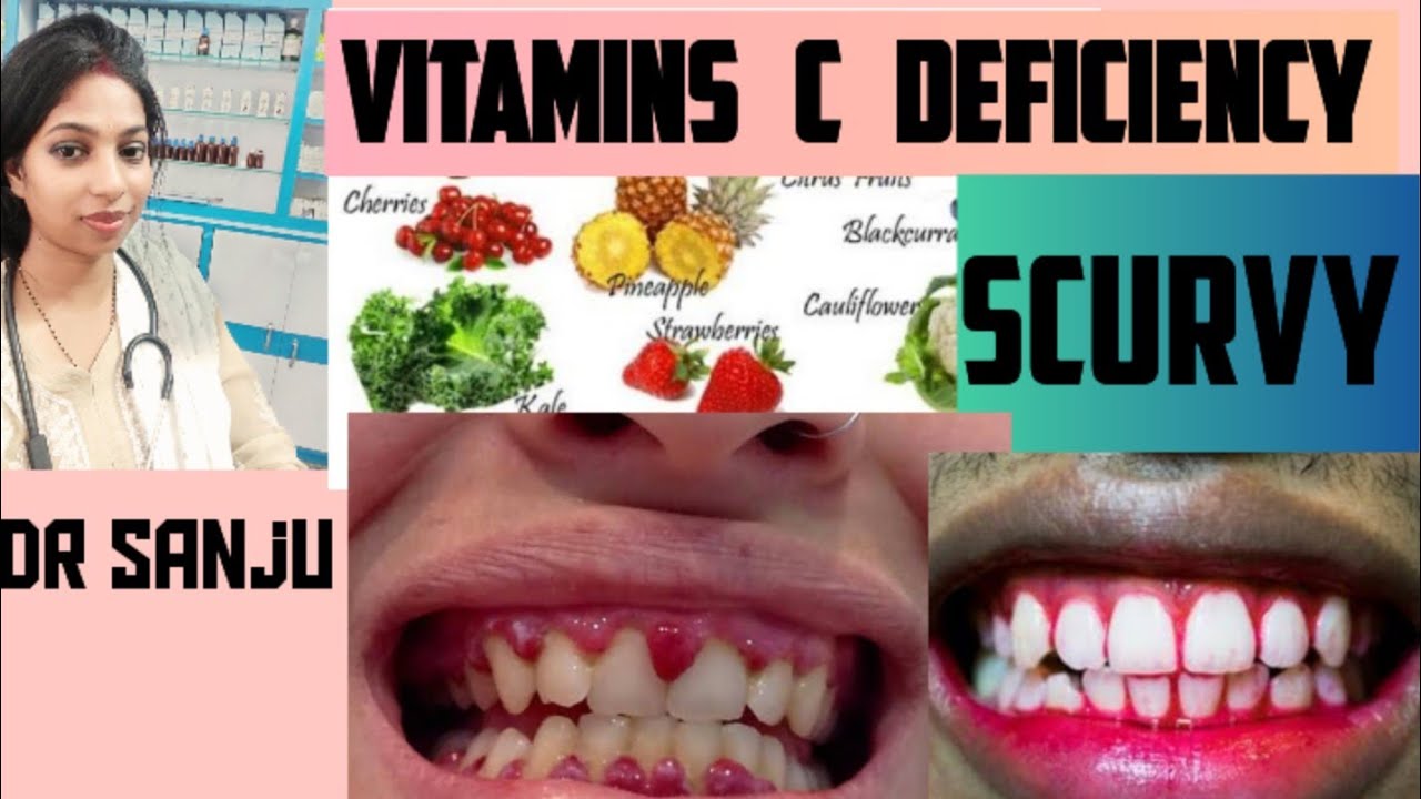 Scurvy! Vitamin C deficiency! Homeopathic natural solution!विटामिन सी