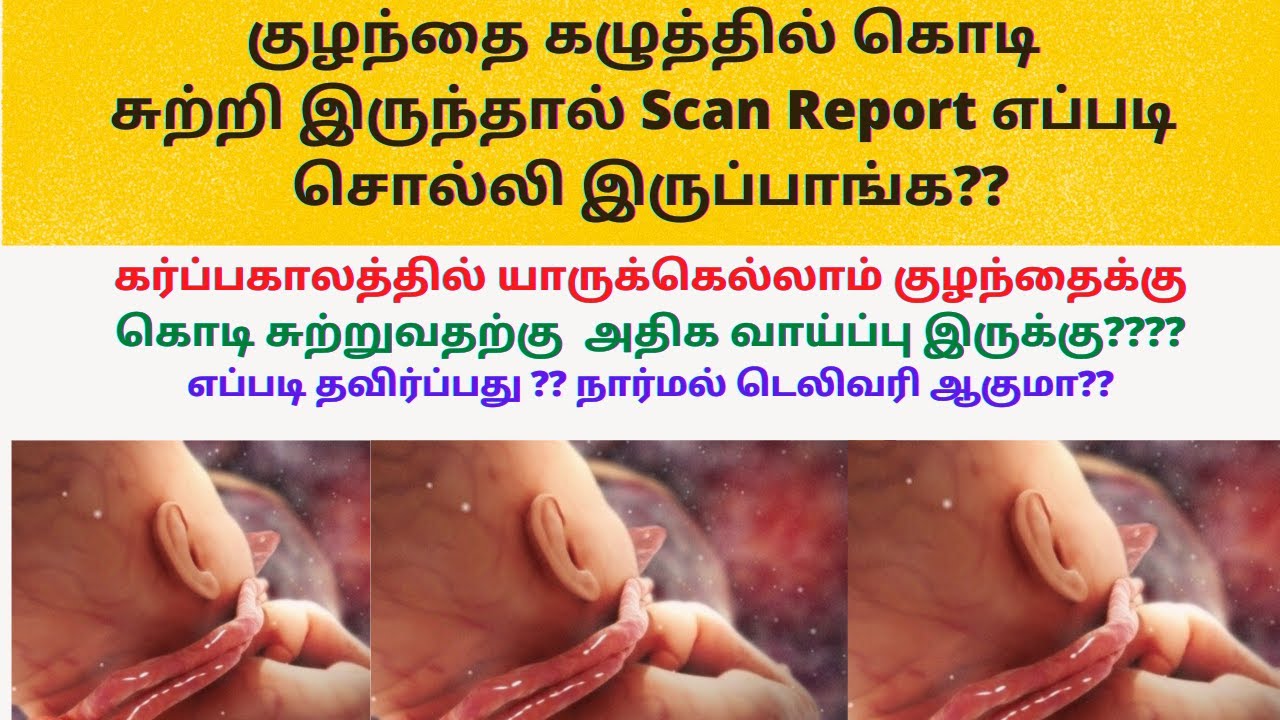 Cord around fetal neck during pregnancy in tamil cord around baby