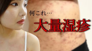 【閲覧注意】突如全身に現れた大量の湿疹。診断結果出ました。