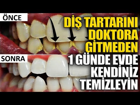 Diş Tartarını Doktora Gitmeden 1 Günde Evde Kendiniz Temizleyin.