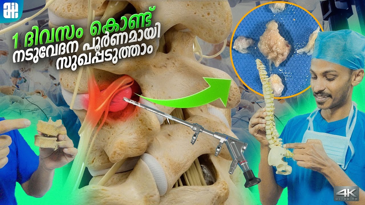 1 ദിവസം കൊണ്ട് നടുവേദന പൂർണമായി സുഖപ്പടുത്താം | PELD Advanced Treatment Full Details