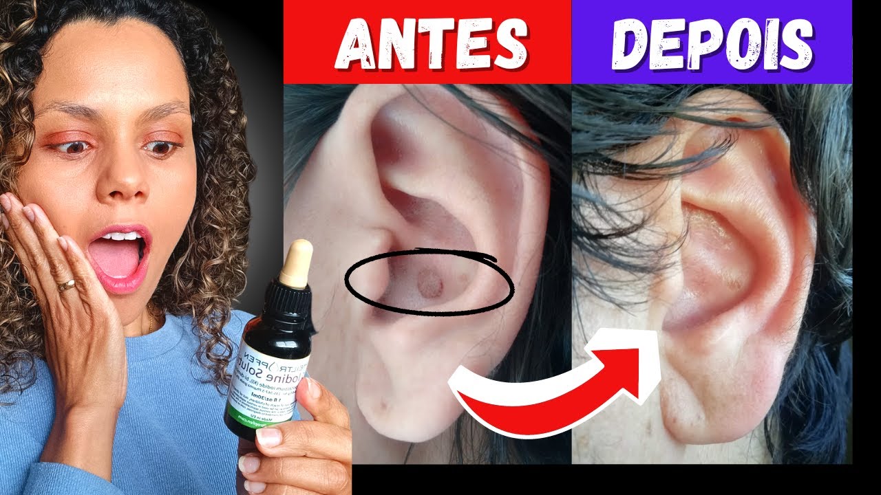 Relato pessoal da cura de um câncer de pele com o uso de LUGOL #lugol ...