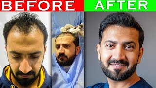My Complete Hair Transplant Experience One Year Journey