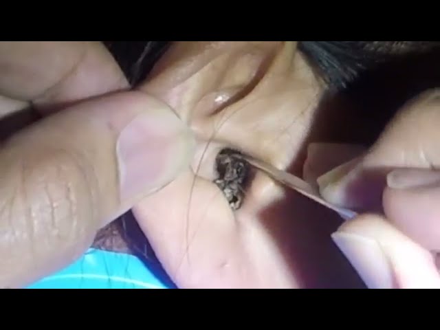 Best Earwax Removal Videos