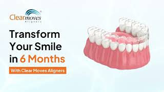 Transform Your Smile With Clear Moves Aligners #clearaligners #invisiblebraces