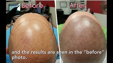 Hair Restoration: Scalp Aesthetics South Florida