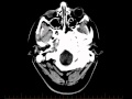 How to read a CT brain in 2 minutes